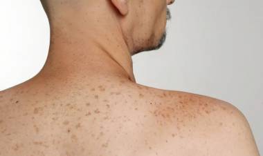 LALCEC realiza una campaña contra el “Cáncer de Piel”